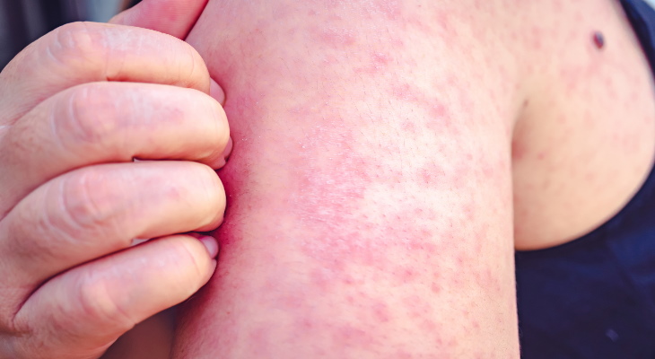 A measles rash on a person&#039;s arm.