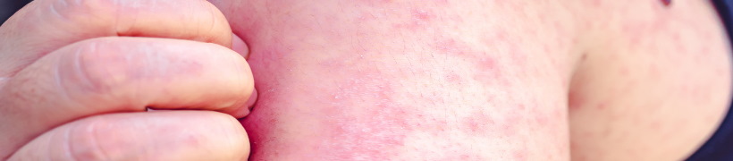 Measles rash on a child's arm.